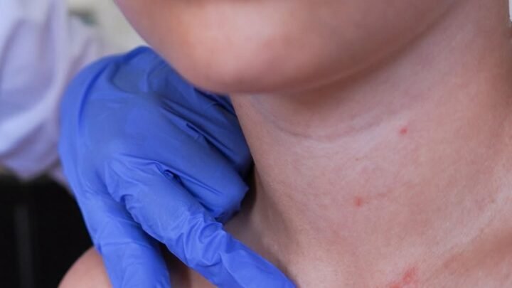 Personal de salud examina un sarpullido visible en el cuello y pecho de un paciente